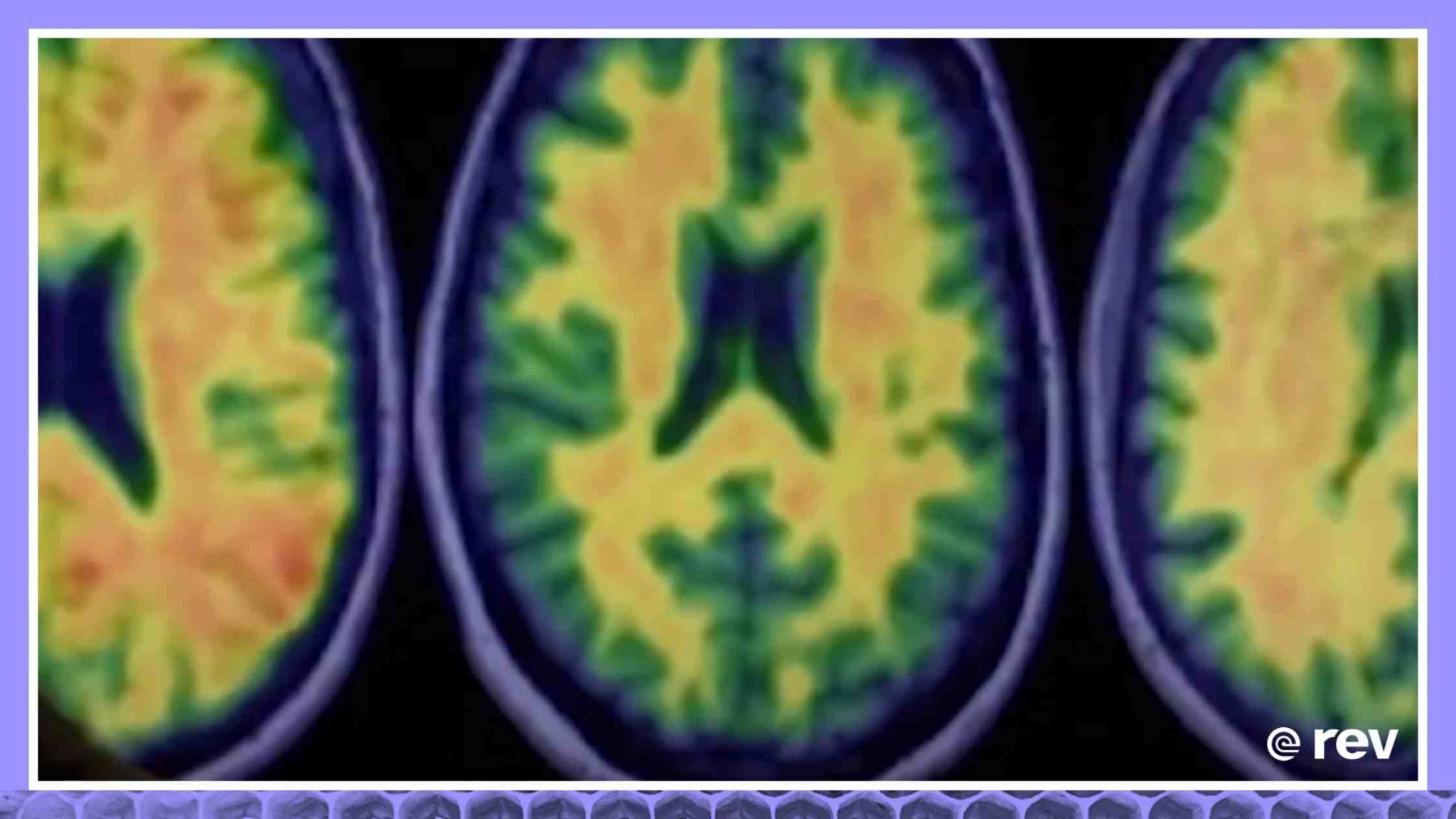 New drug could be Alzheimer's breakthrough Transcript